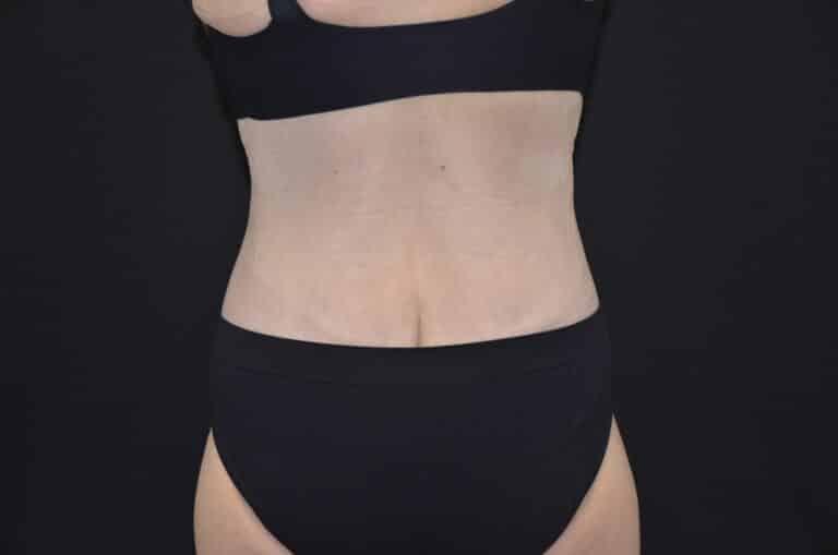 After Image: Tummy Tuck - back