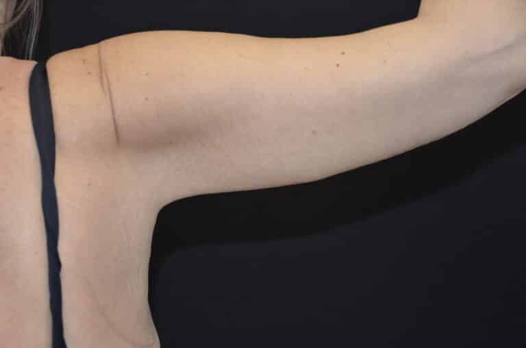 After Image: Brachioplasty - back