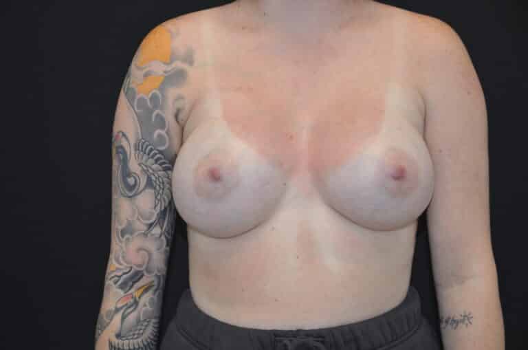 After Image: Breast Augmentation - front