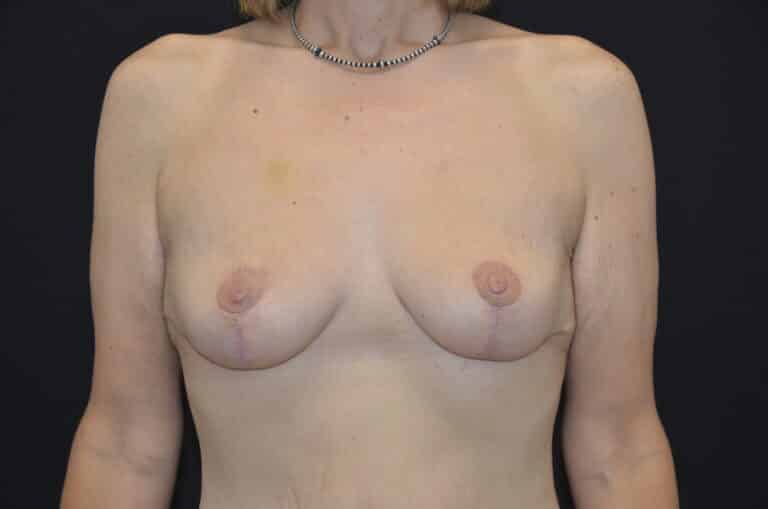 After Image: Breast Lift - front