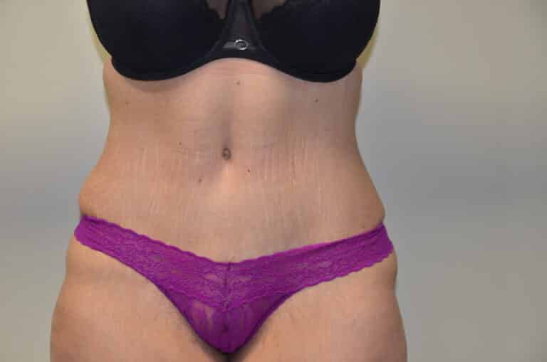 After Image: Tummy Tuck - front