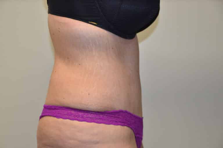 After Image: Tummy Tuck - right-side