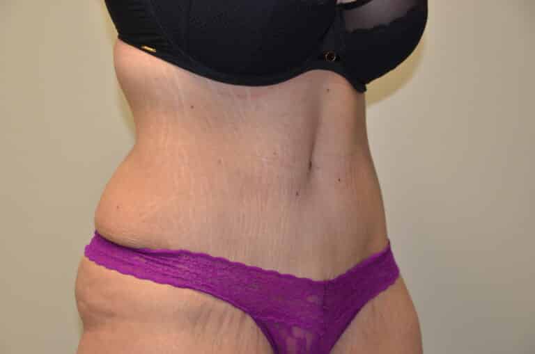 After Image: Tummy Tuck - right-front-oblique