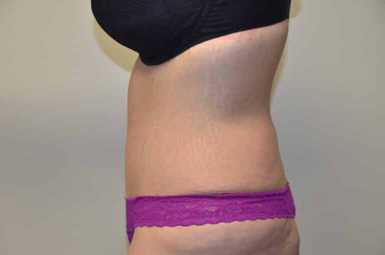 After Image: Tummy Tuck - left-side