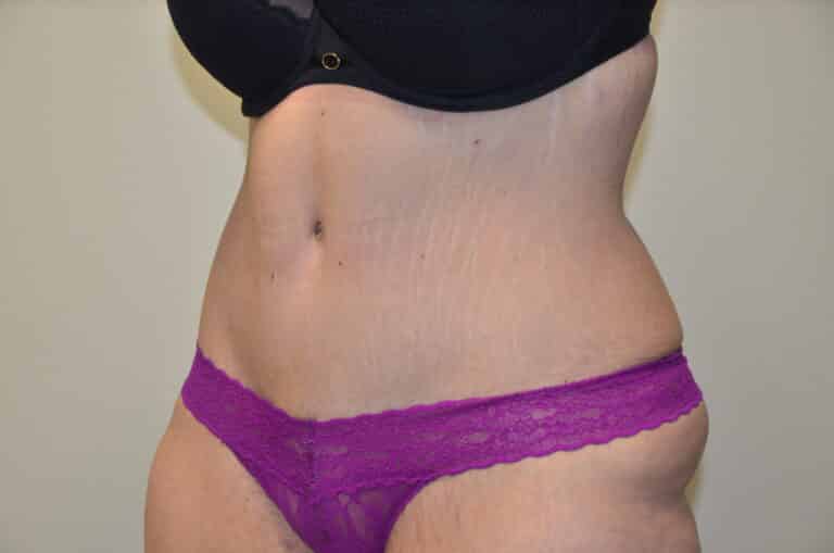 After Image: Tummy Tuck - left-front-oblique