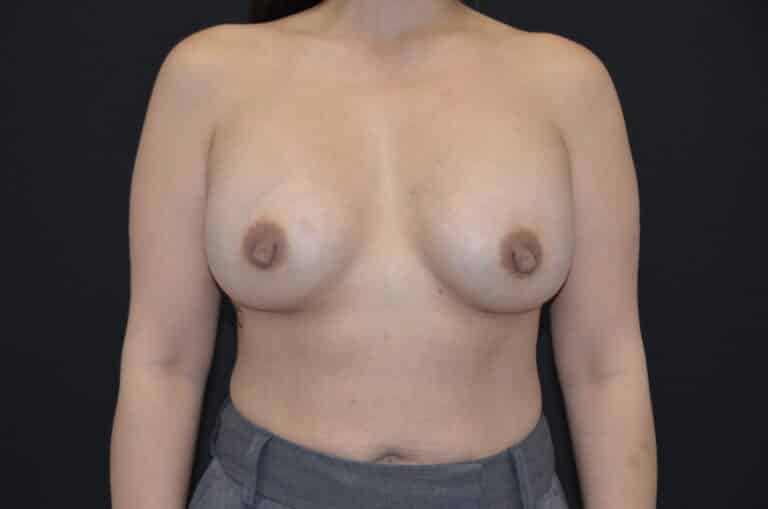 After Image: Breast Augmentation - front