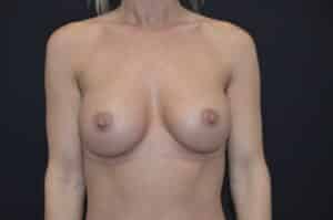 After Image: Breast Augmentation