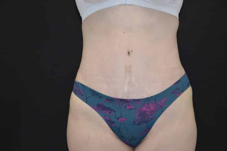 After Image: Tummy Tuck - front