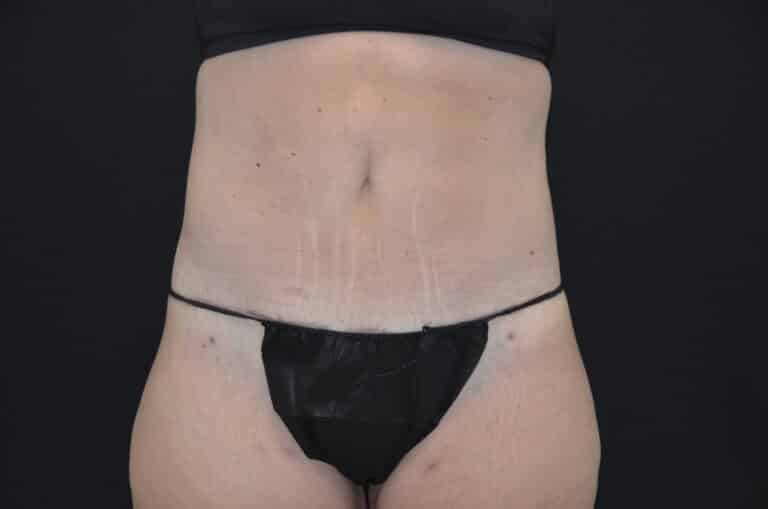 After Image: Tummy Tuck - front