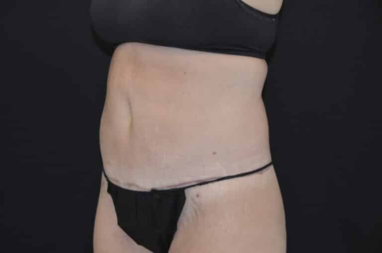 After Image: Tummy Tuck - left-front-oblique