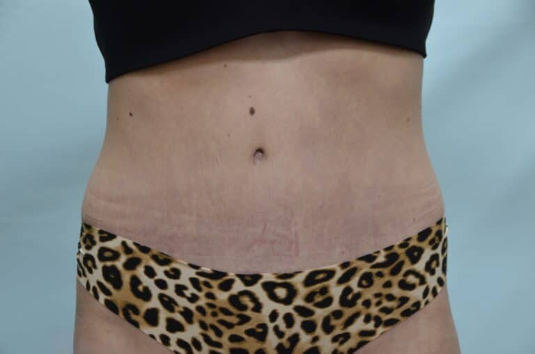 After Image: Tummy Tuck - front