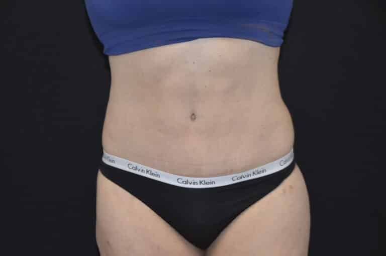 After Image: Tummy Tuck - front