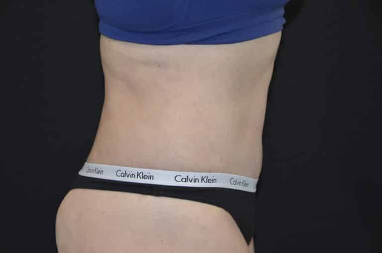 After Image: Tummy Tuck - right-side