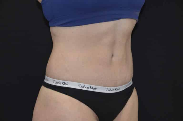 After Image: Tummy Tuck - right-front-oblique