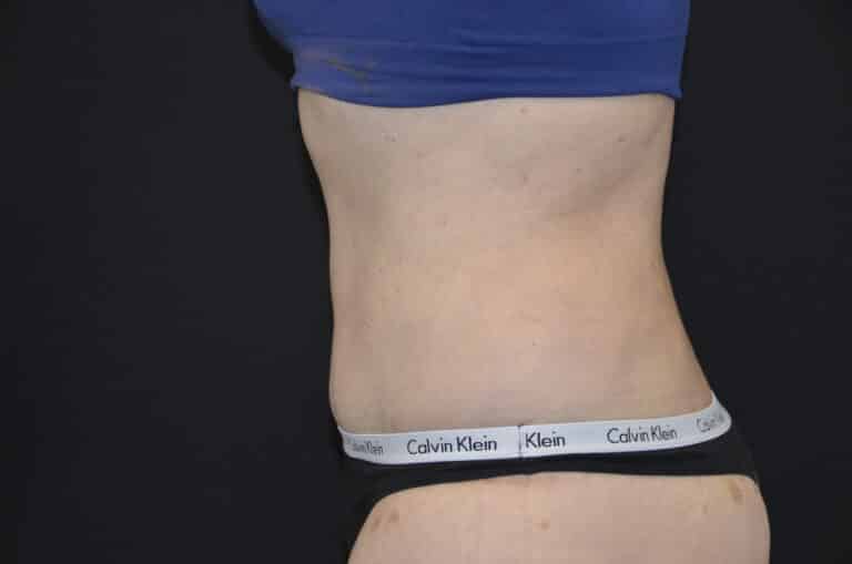 After Image: Tummy Tuck - left-side