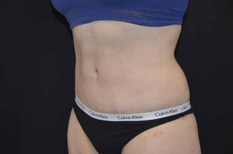 After Image: Tummy Tuck - left-front-oblique