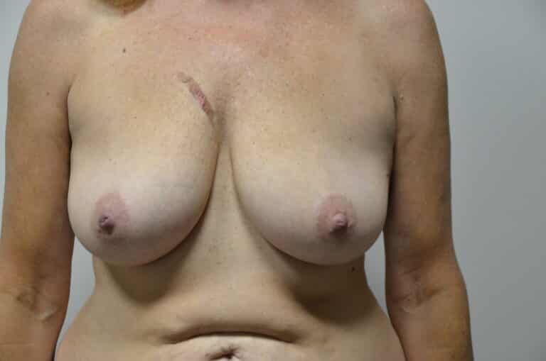 Before Image: Breast Lift - front