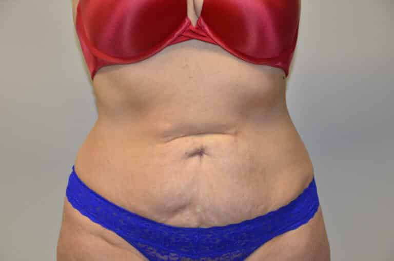 Before Image: Tummy Tuck - front