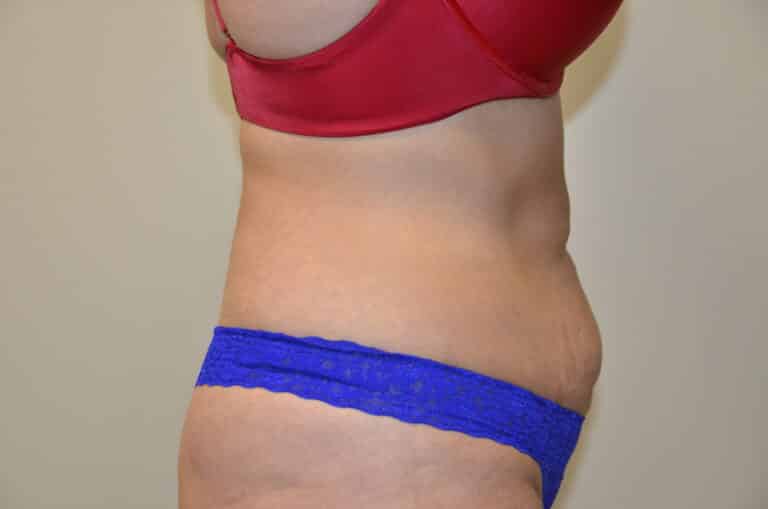 Before Image: Tummy Tuck - right-side