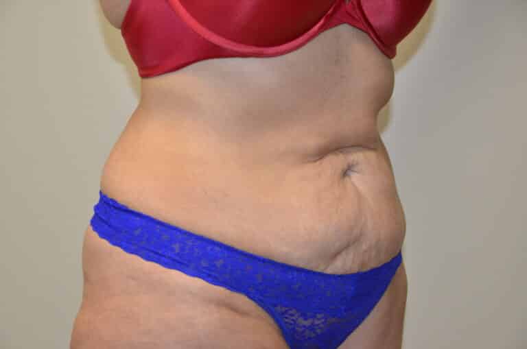 Before Image: Tummy Tuck - right-front-oblique