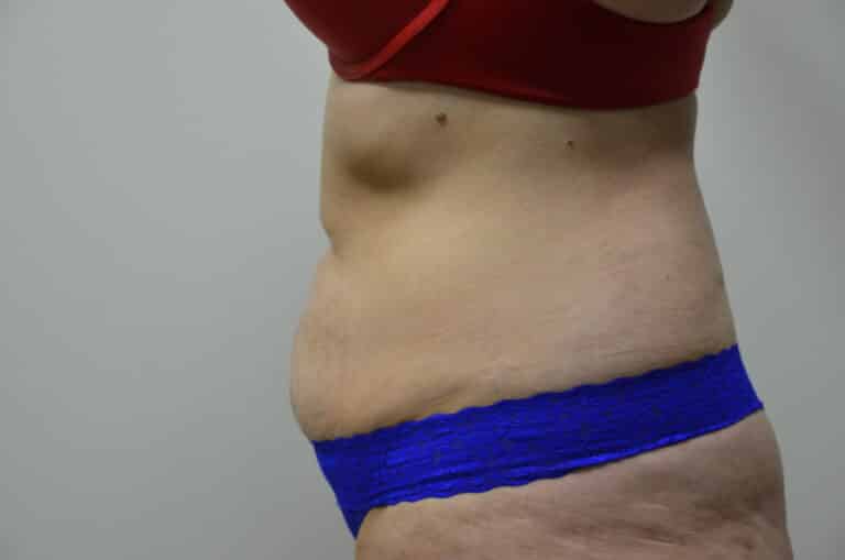 Before Image: Tummy Tuck - left-side