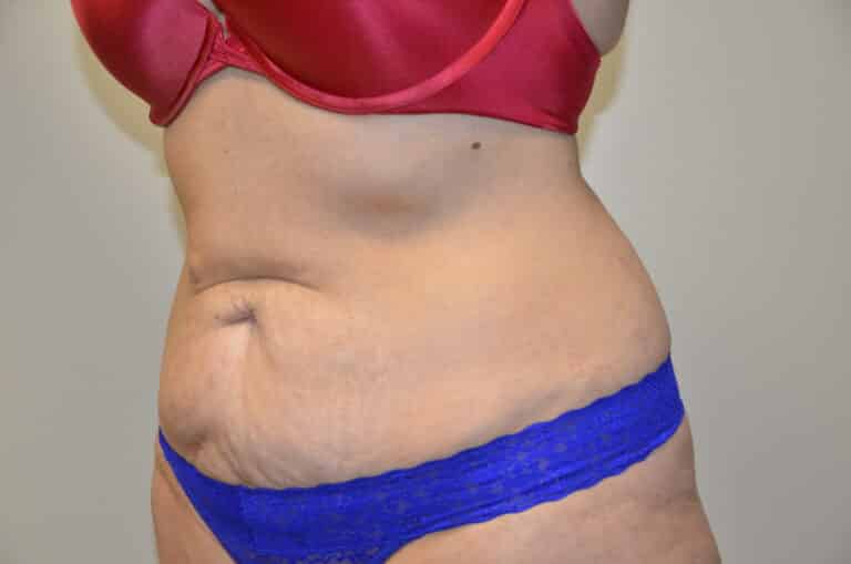 Before Image: Tummy Tuck - left-front-oblique