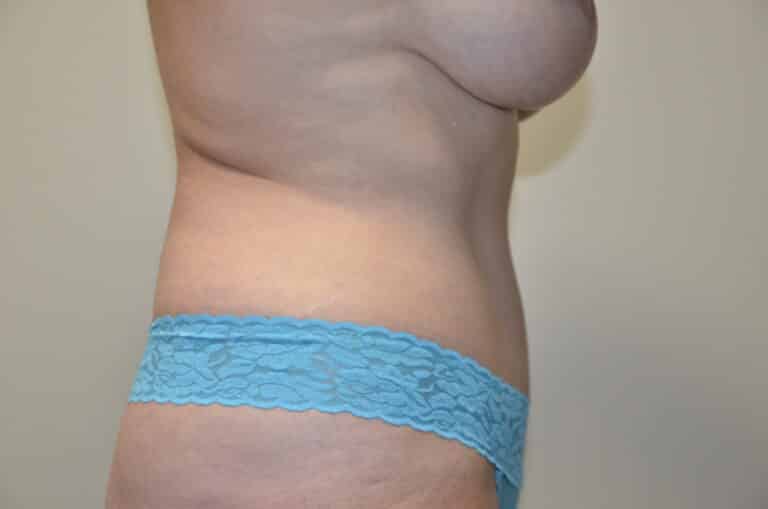 After Image: Tummy Tuck - right-side