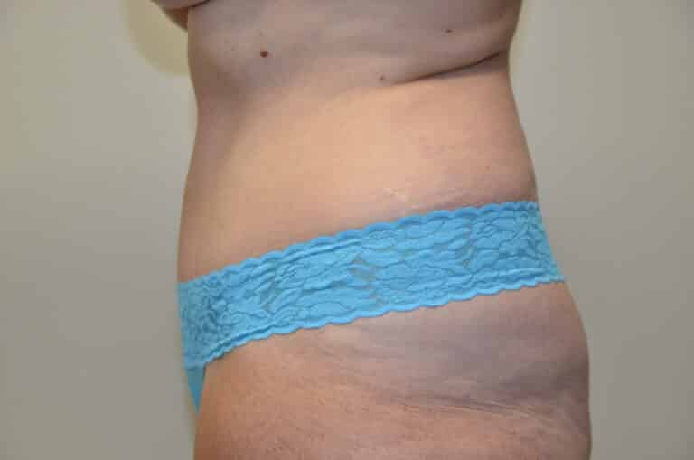 After Image: Tummy Tuck - left-side