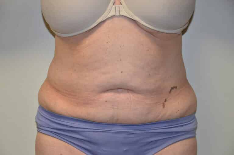 Before Image: Tummy Tuck - front