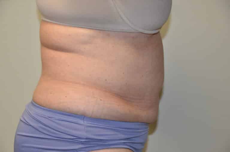 Before Image: Tummy Tuck - right-side