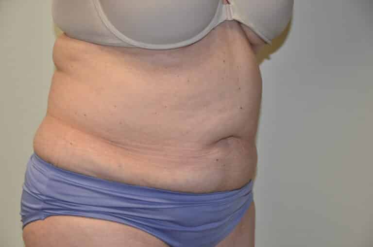 Before Image: Tummy Tuck - right-front-oblique