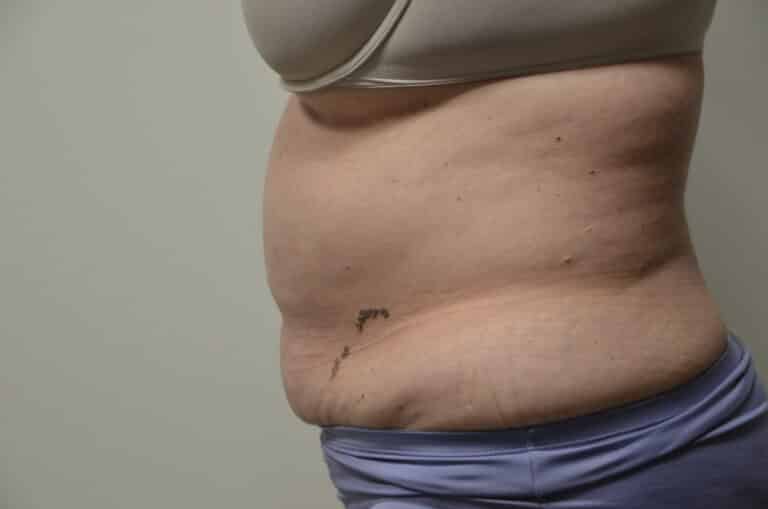 Before Image: Tummy Tuck - left-side