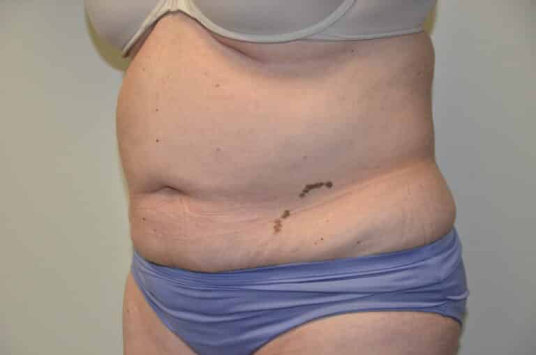 Before Image: Tummy Tuck - left-front-oblique