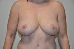 After Image: Breast Lift with Implants