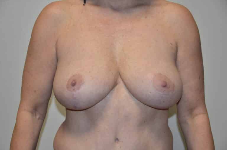 After Image: Breast Lift with Implants - front