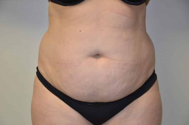 Before Image: Tummy Tuck - front