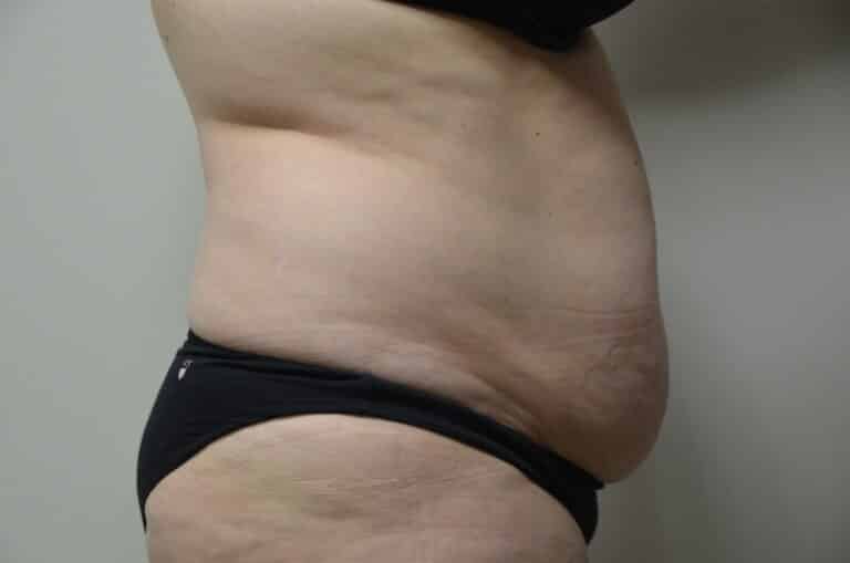 Before Image: Tummy Tuck - right-side