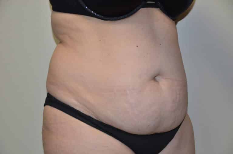 Before Image: Tummy Tuck - right-front-oblique