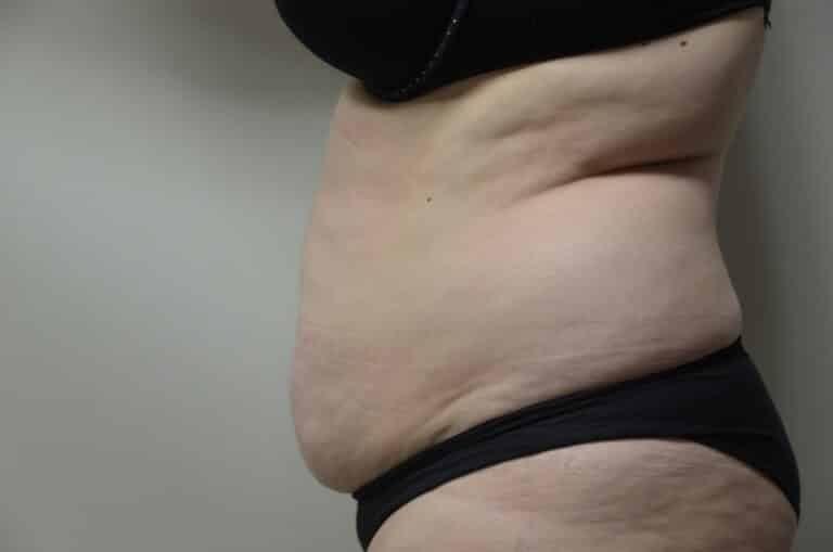 Before Image: Tummy Tuck - left-side