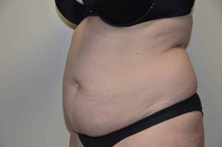 Before Image: Tummy Tuck - left-front-oblique