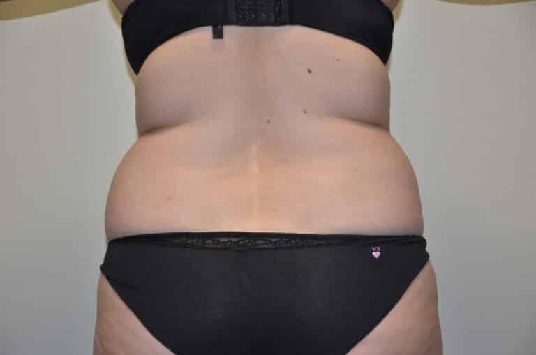 Before Image: Tummy Tuck - back