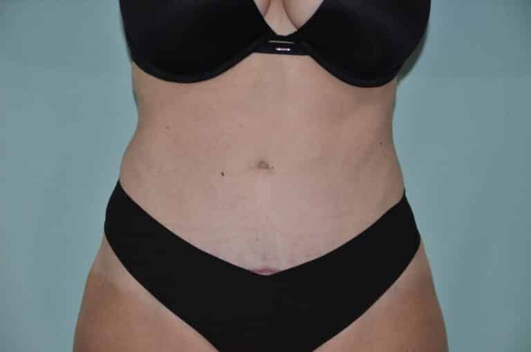 After Image: Tummy Tuck - front