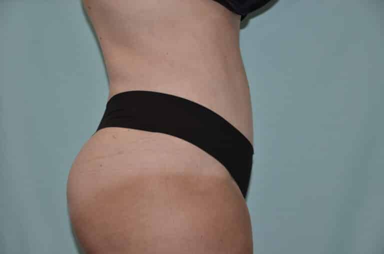 After Image: Tummy Tuck - right-side