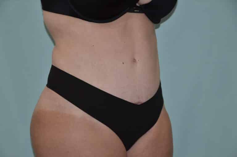 After Image: Tummy Tuck - right-front-oblique