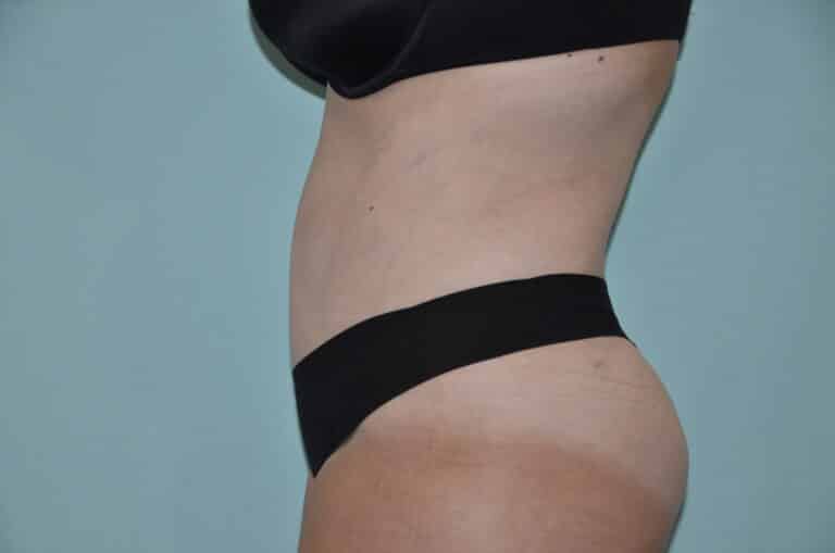 After Image: Tummy Tuck - left-side