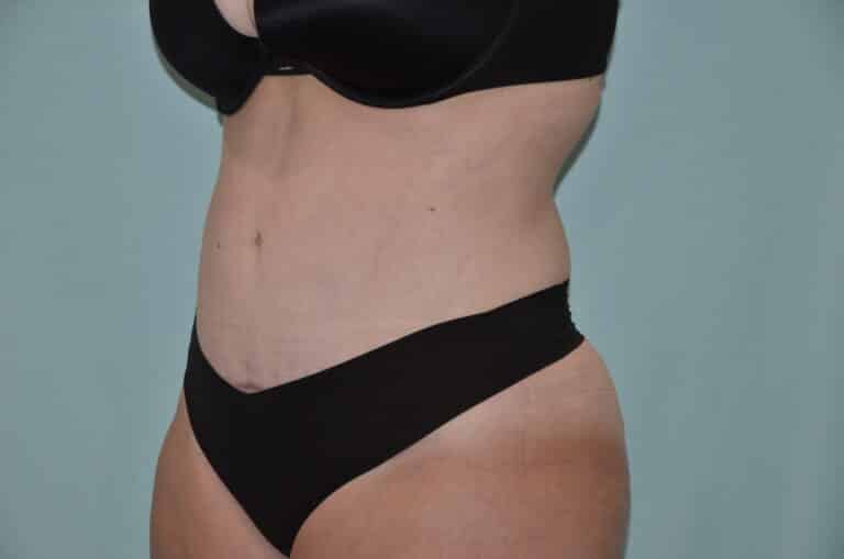 After Image: Tummy Tuck - left-front-oblique