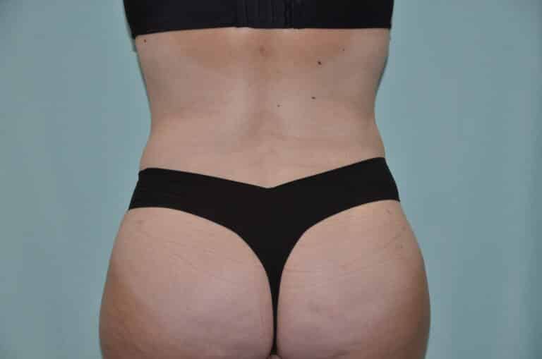 After Image: Tummy Tuck - back