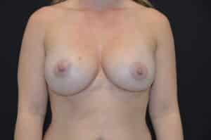 After Image: Breast Augmentation