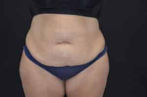 Before Image: Tummy Tuck