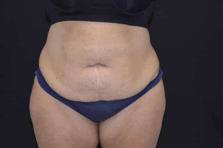 Before Image: Tummy Tuck - front